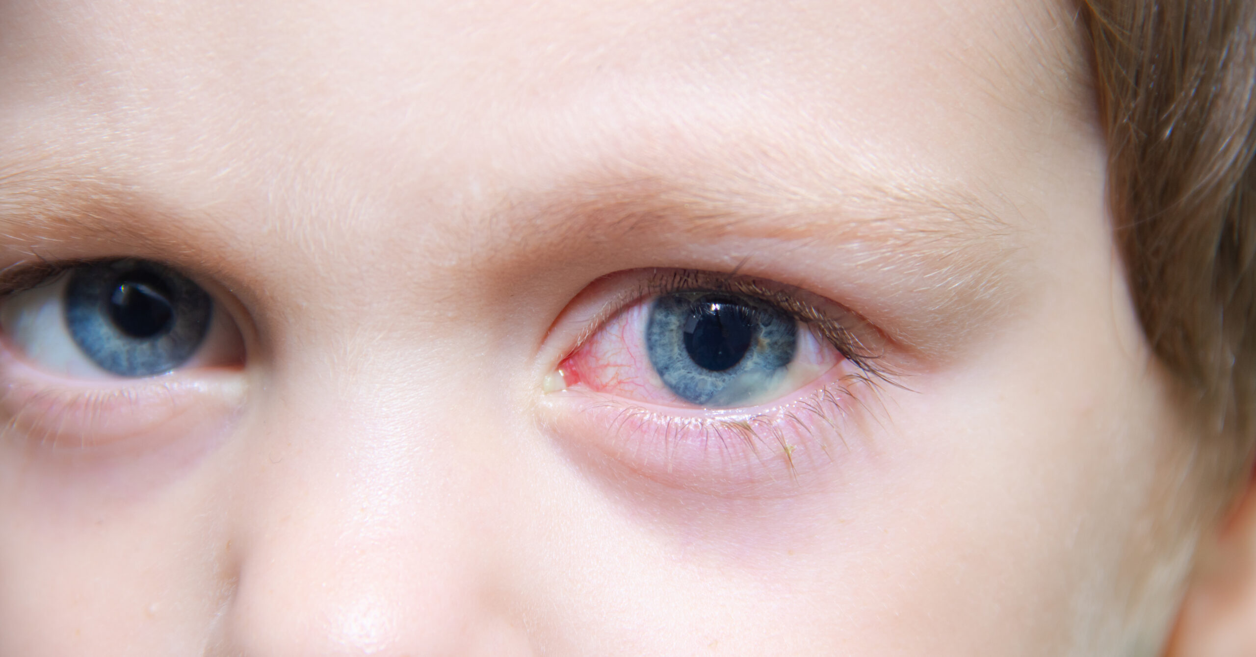 Синдром «червоного ока»
