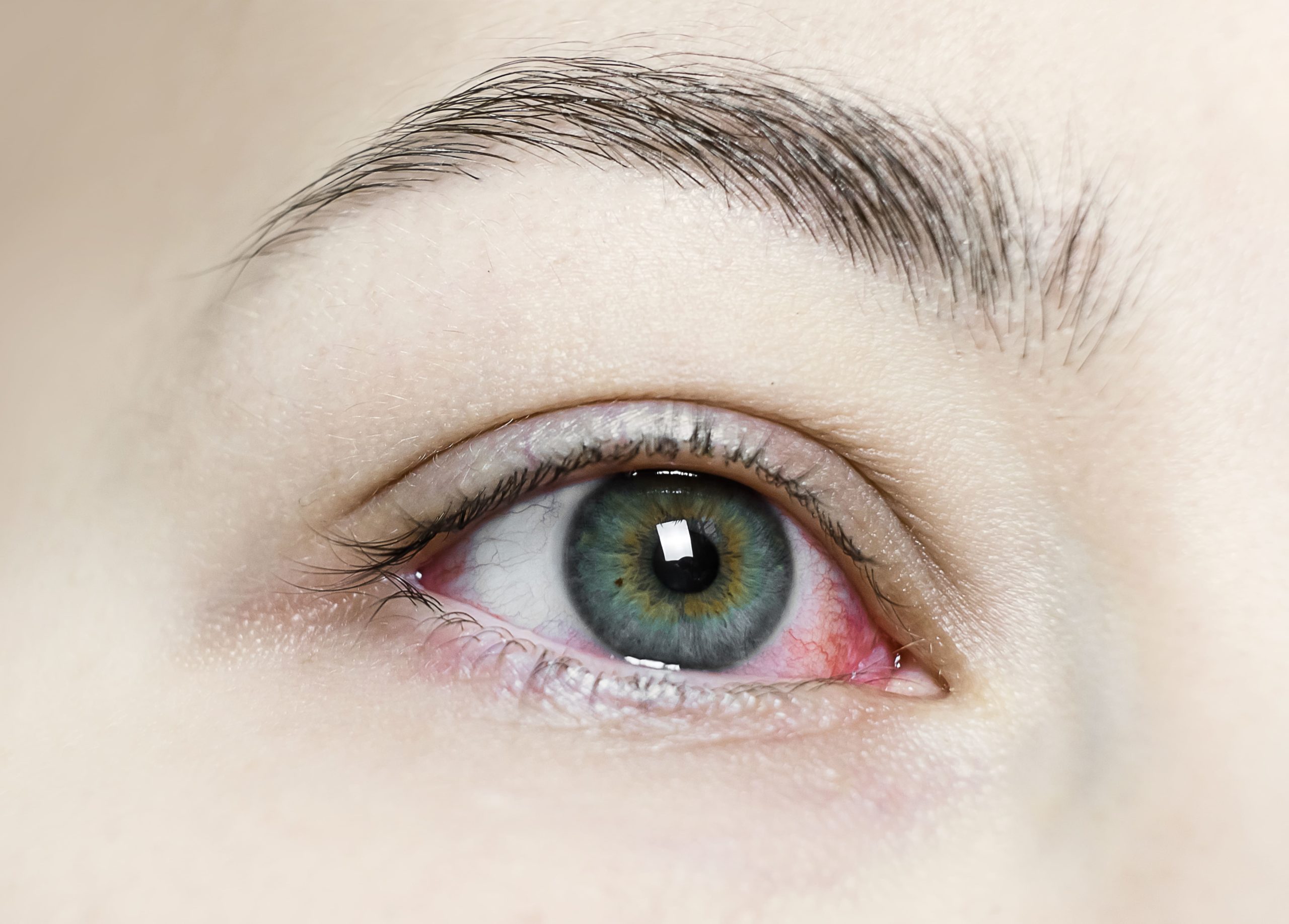 Что делать, если “простудили” глаз?